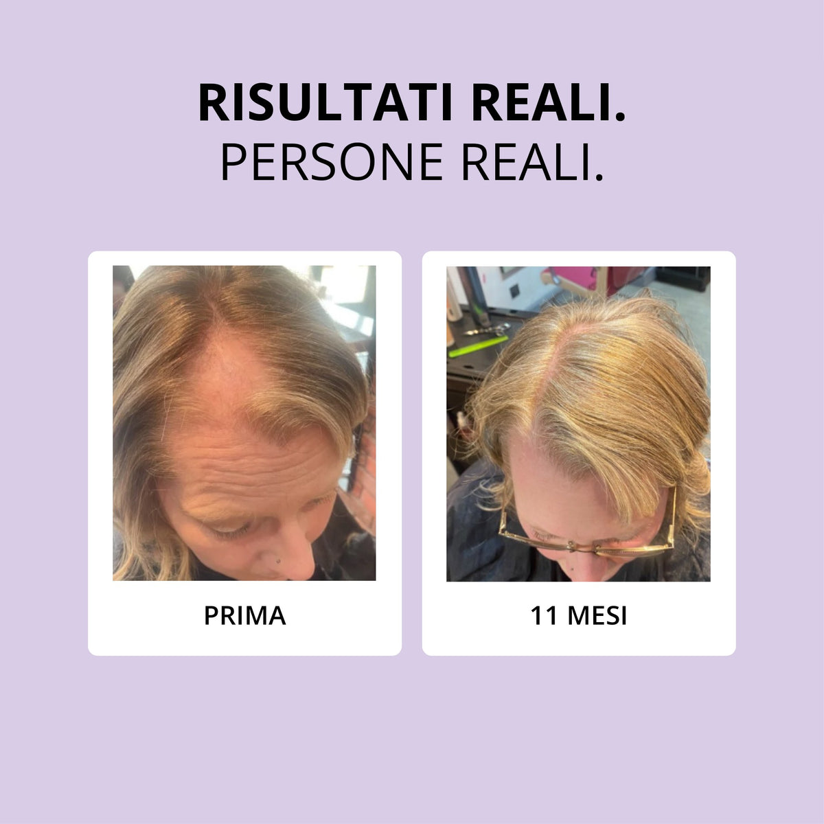 Glowwa Hair Food Meno: risultati reali, prima e dopo 11 mesi